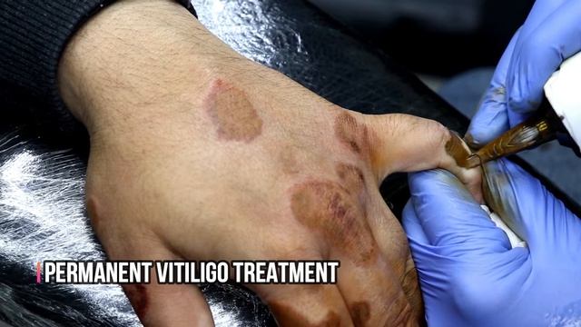 Permanent Makeup For Vitiligo - Vitiligo Cover Up Tattoo - Micro-pigmentation For Vitiligo