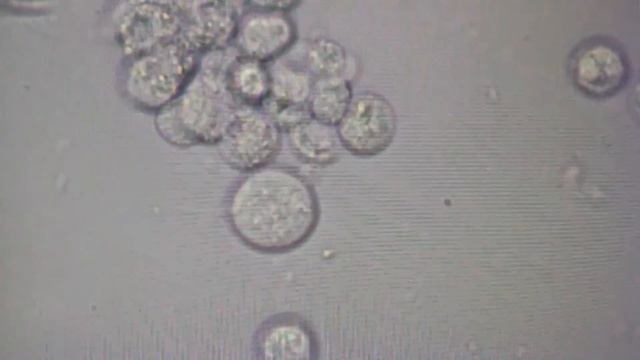 ТРИХОМОНАДА в моче - ЖИВЫЕ - МНОГО!!!!!!!!!! TRICHOMONAD are in urine - LIVING - MUCH!!!