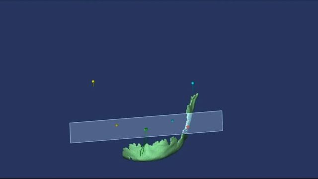 Анализ движений нижней челюсти с визуализацией суставов