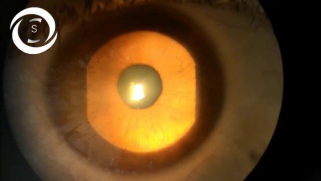 Pupillary Hippus