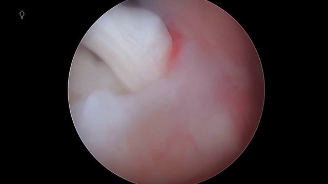 My Shoulder Rotator Cuff & Bicep Tendon Repair Surgery! Real Footage and Commentary from my Surgeon