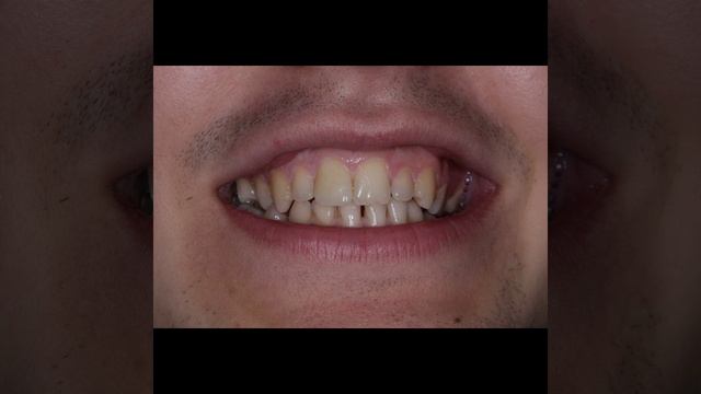 Скол зуба - лечение