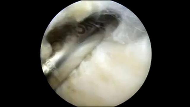 Full Length Endoscopic Adhesiolysis of the Achilles Tendon and Triceps Surae