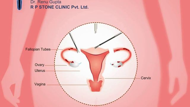 Animation of Total Laparoscopic Hysterectomy