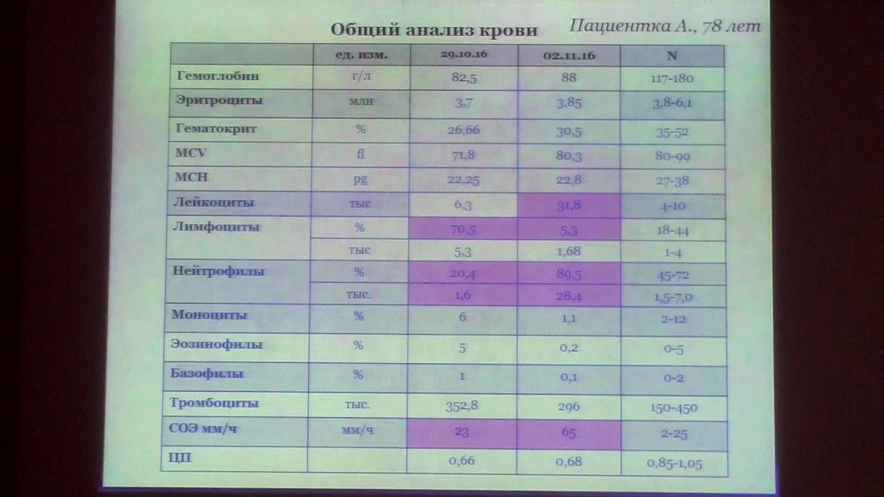 52 Киселева ОЮ Клиническое наблюдение пациентки с осложненным течением дивертикулярной болезни