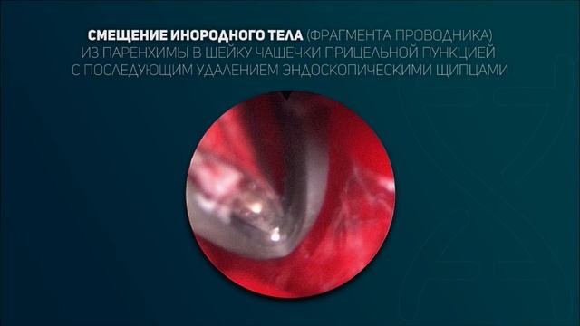 Лазерная литотрипсия. Видео 8.