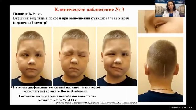 Пластика лиц/ нерва жевательным для реабилитации пац-в со стойким параличом мимической мускулатуры