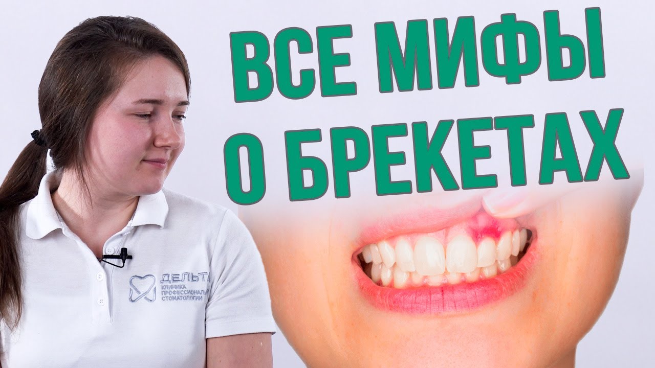 ТОП 10 МИФОВ О БРЕКЕТАХ