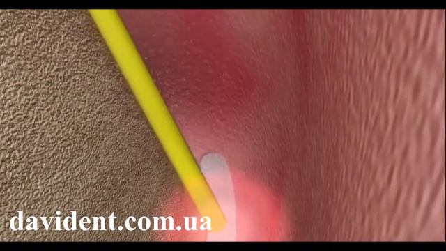 Лазерная стоматология