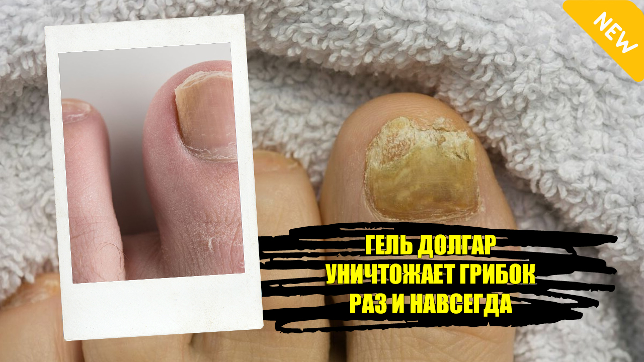 ☑ Крем фундизол отзывы при грибке ногтей
