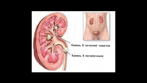 Образование камней в почках