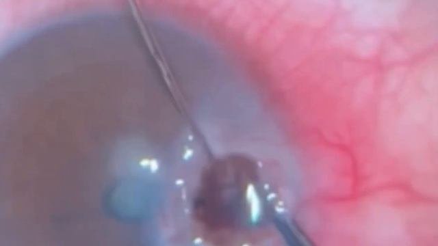 Elimination of perforated corneal ulcer and iris prolapse. Устранение перфоративной язвы роговицы