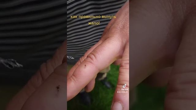 как правильно достать жало пчелы