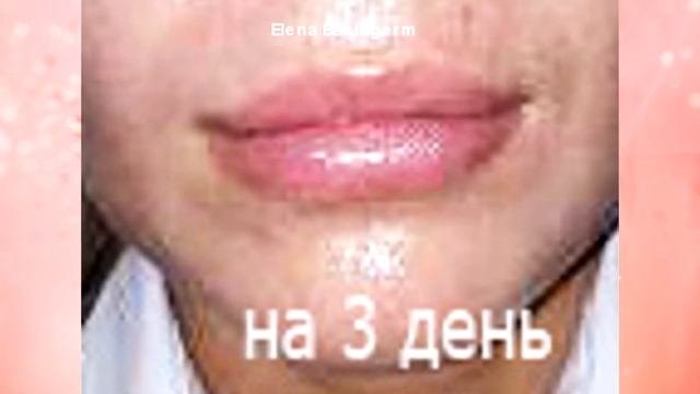 Увеличение губ филлерами.  Врач косметолог Елена Бэкингерм