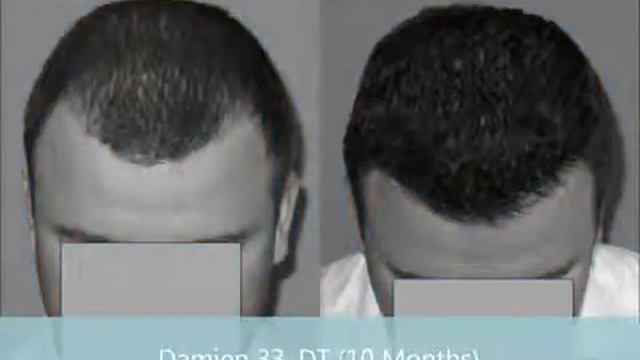 Hair Loss Treatment For Men and Women FDA  Approved