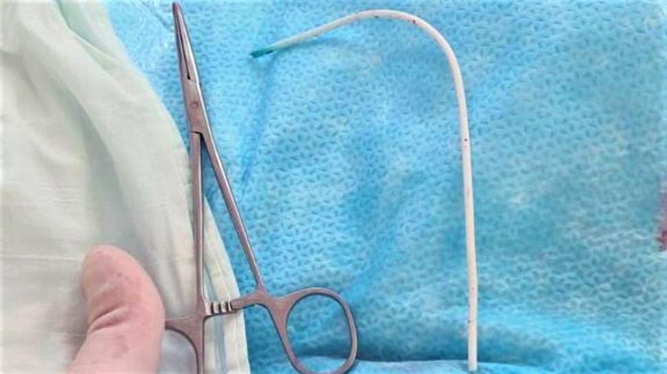 Югре из сердца пациентки достали 12-сантиметровый катетер