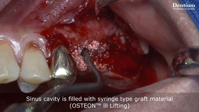 Sinus lifting by hydraulic pressure using Dentium's Sinus Elevator (Live)