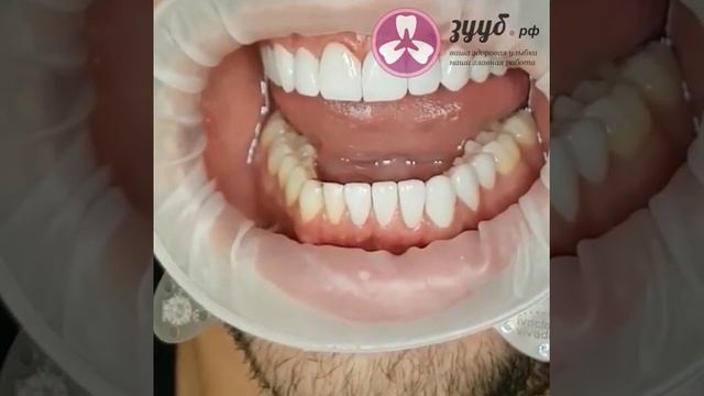 Установка виниров