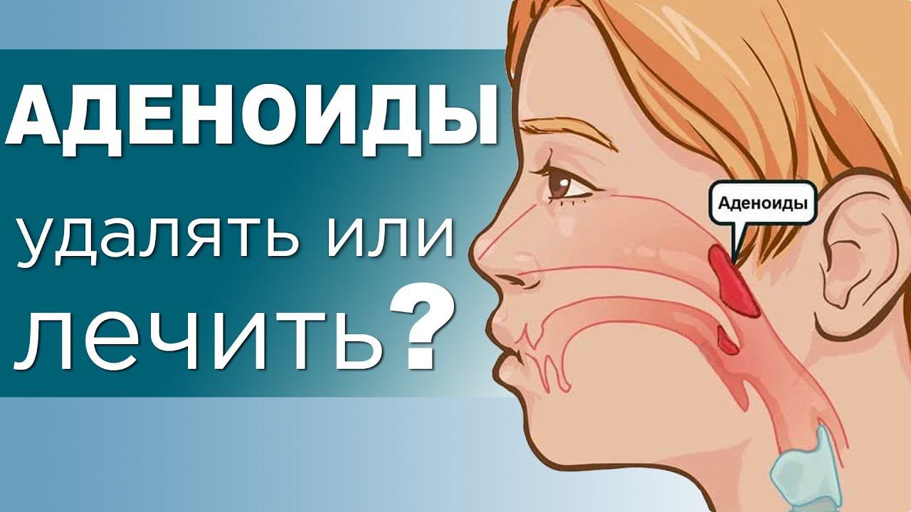 АДЕНОИДЫ у детей. Степени, осложнения и лечение