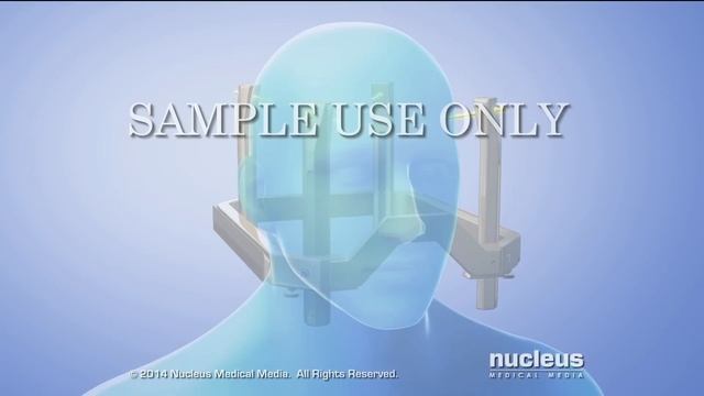 Gamma Knife® (Stereotactic Radiosurgery)