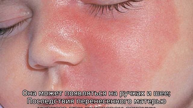 Красные пятна на лице у новорожденного ребенка