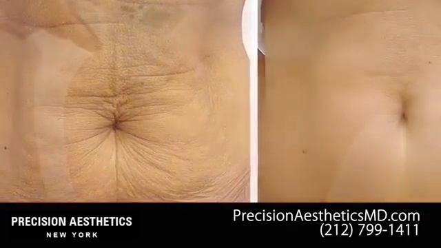 Exilis and Thermage Cosmetics