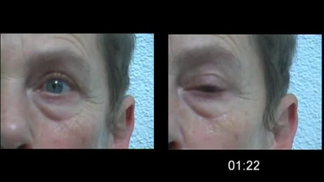 AESTHETIC supreme direct eye lift contour des yeux