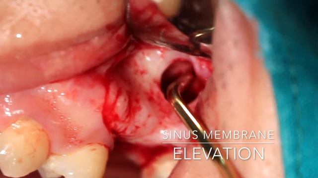 Lateral Sinus Lift Full ver