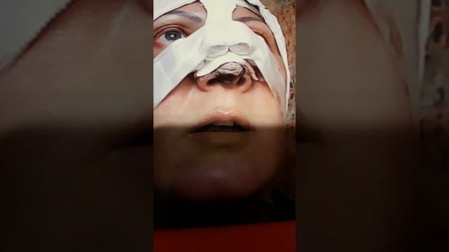 Русецкий Ринопластика . Ужас! Где мой красивый нос ?