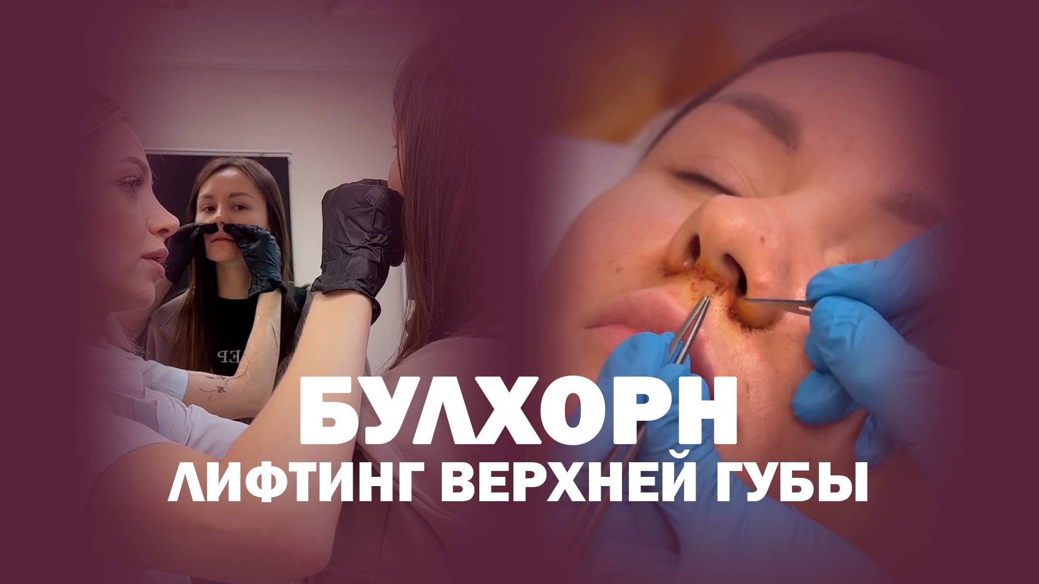 Пластика верхней губы Булхорн