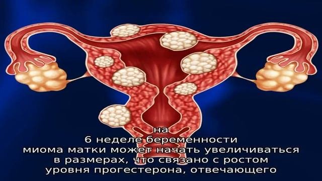 Миома матки при беременности  не приговор?