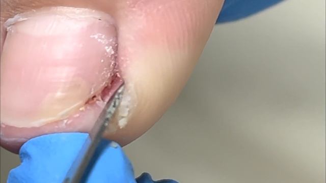 Oh~ Poor toenail has a missing part, trim it【Xue Yidao】