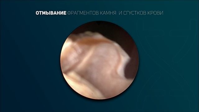 Лазерная литотрипсия. Видео 6.