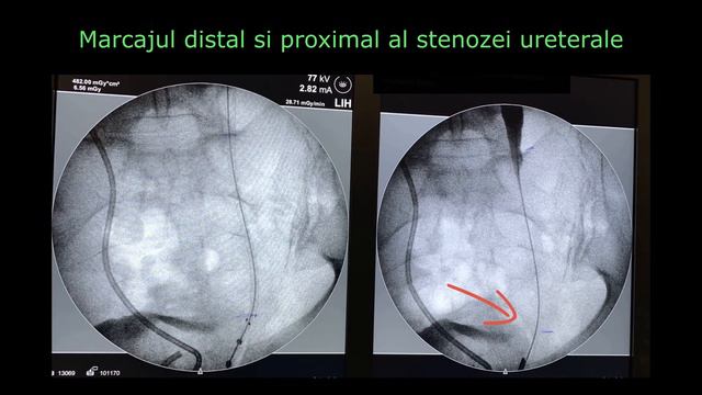 Allium Stent ureteral expandabil - Stenoza ureterala
