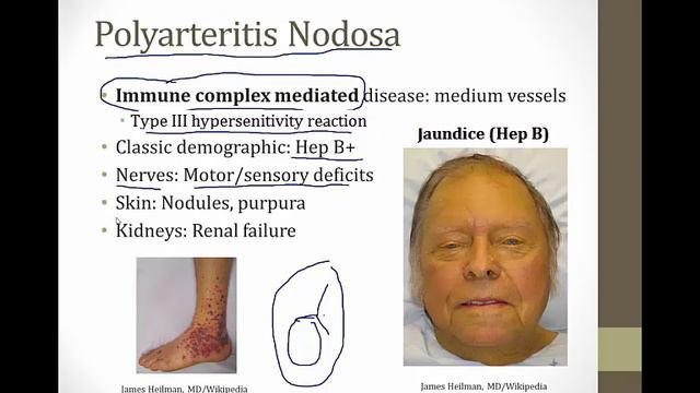 Vasculitis