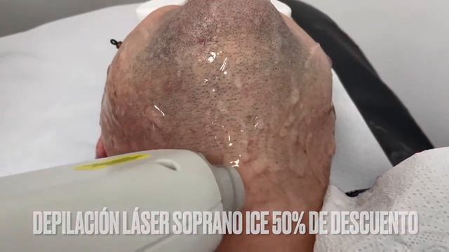 Depilación Láser Barba. Soprano Ice ?⚕️?⚕️