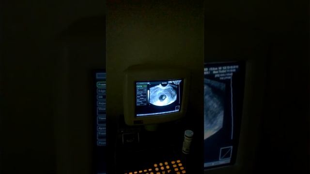 Беременность 7 недель  активное сердцебиение