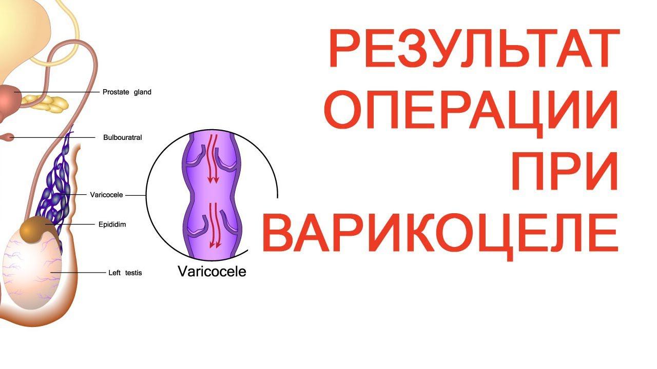 Результат операции при варикоцеле / Доктор Черепанов