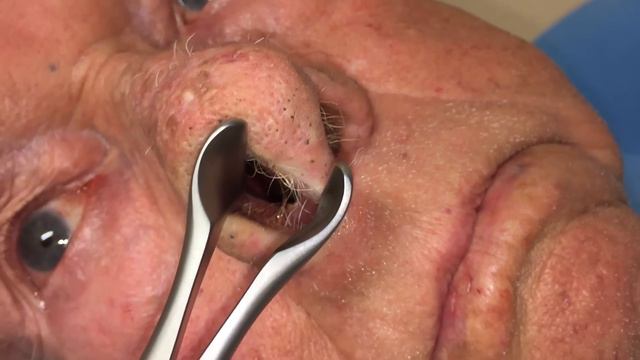 Epistaxis | Auburn Medical Group
