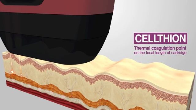Cellthion[High Intensity Focused Ultrasound(HIFU)]_Daeyang Medical