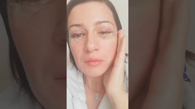 1й день после блефаропластики