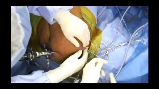 Biceps Tenodesis - High In The Groove