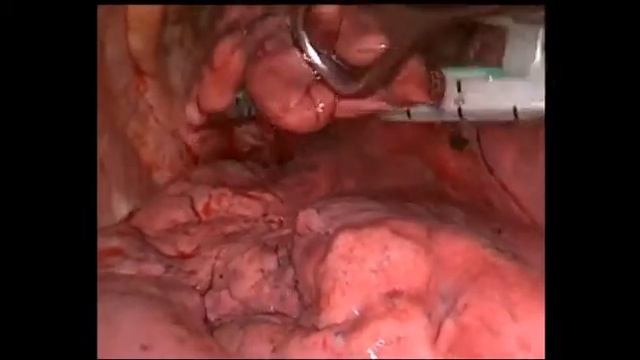 Поиск очагов легкого при торакоскопии. Search Lung Foci With Thoracoscopy
