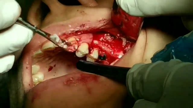 Sinus lifting, bone grafting and implant