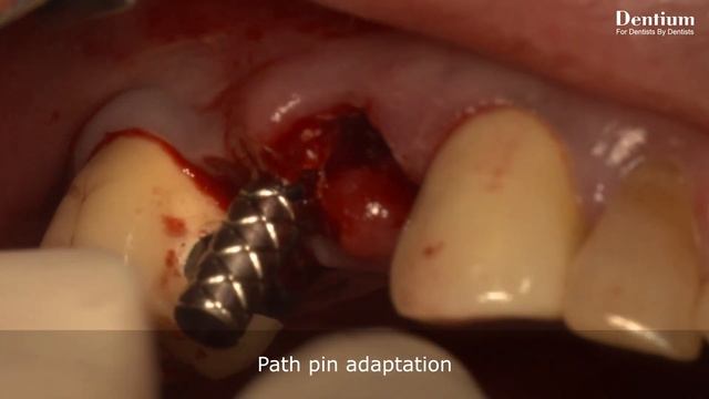 Sinus lifting with simple GBR using Osteotome (Prof. Soo-Hwan Byun commentary)