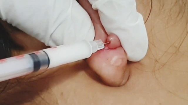 Ear Keloid Treatment - Eilam's Masterclass by Dr. Anuj Pall