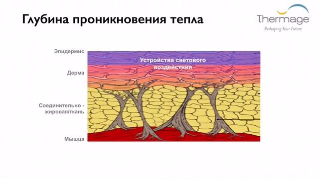 Самая эффективная процедура против дряблой кожи - термолифтинг Thermage