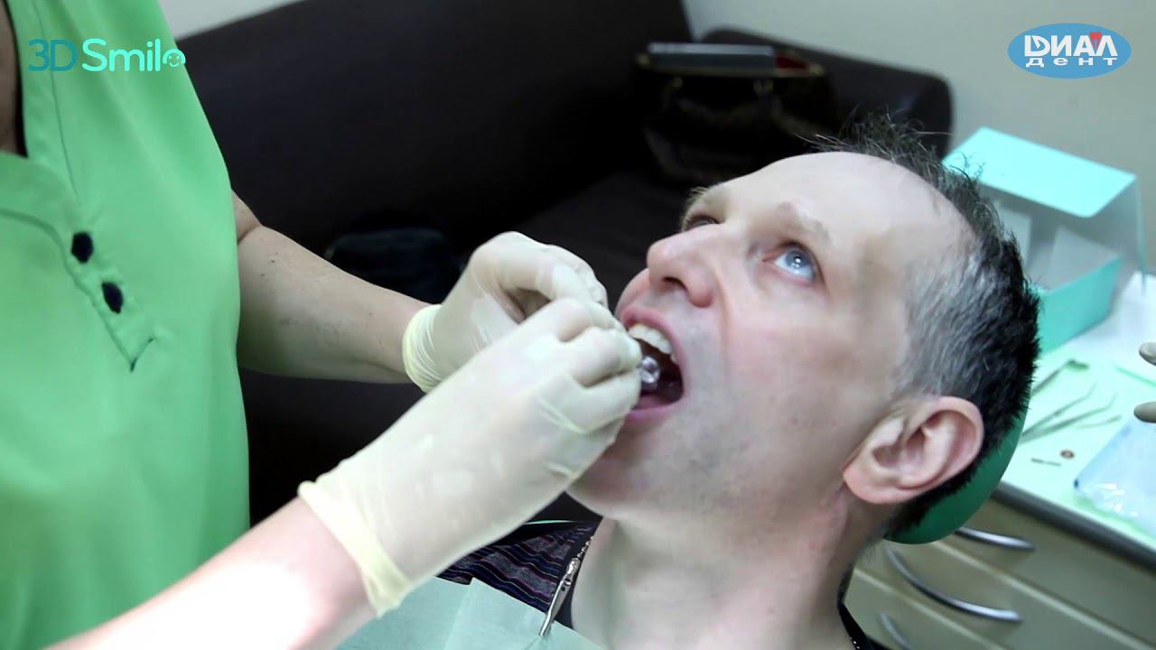 Выравнивание зубов каппами по системе 3D Smile