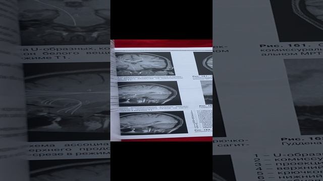 Томографическая (КТ и МРТ) анатомия центральной нервной системы человека. Атлас
