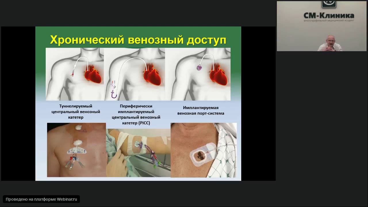 Запись вебинара «Имплантируемые порт системы» - Лёвин В.В. (17.07.2018)